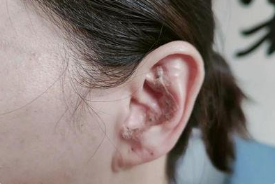 10脂溢性皮炎的耳穴疗法你知多少临沂皮肤科最好的医院