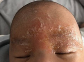 12新生儿脂溢性皮炎如何治疗临沂皮肤科最好的医院